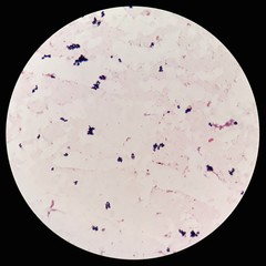 Smear of human blood cultured Gram's stained with gram positive cocci in cluster bacteria, under...