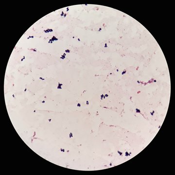 Smear of human blood cultured Gram's stained with gram positive cocci in cluster bacteria, under 100X light microscope (Selective focus).