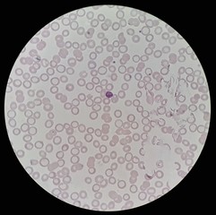 Under 100X light microscope, human parasite on thin film of blood smear with Plasmodium ovale...