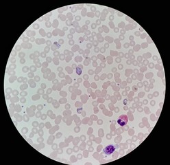 Under 100X light microscope, human parasite on thin film of blood smear with Plasmodium vivax form...