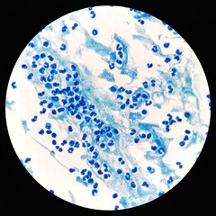Smear of Acid-Fast bacilli (AFB) stained from sputum specimen with numerous white blood cells (WBC), under 100X light microscope.