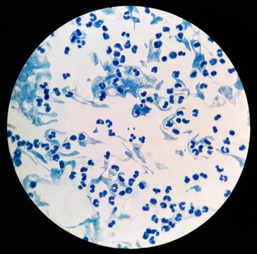 Smear of Acid-Fast bacilli (AFB) stained from sputum specimen with numerous white blood cells (WBC), under 100X light microscope.