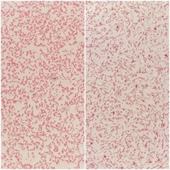 Two smear patterns of human blood cultured Gram's stained with gram negative bacilli bacteria under...