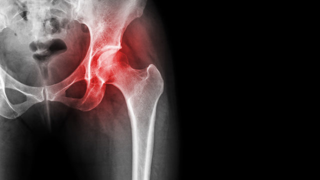 Arthritis At Hip Joint . Film X-ray Show Inflamed Of Hip Joint And Blank Area At Right Side . Avascular Necrosis Concept