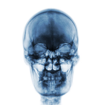 Film x-ray of normal human skull on isolated background . Front view