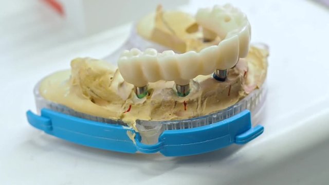 Dental technician is working monolithic zirconia restorations full arch implant