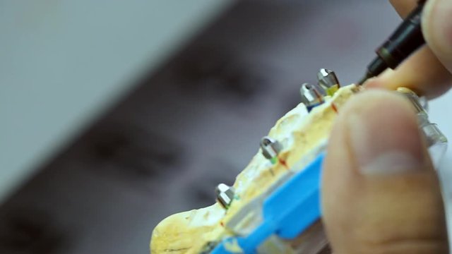 Dental technician is working monolithic zirconia restorations full arch implant