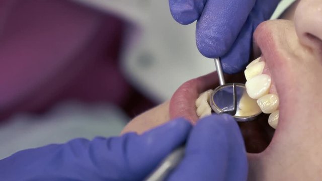 Dentist puts dental veneers patient