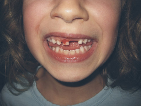 Close up of smiling young girl with missing tooth and bloody mouth