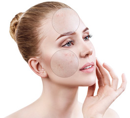Circles shows problem skin of young woman.