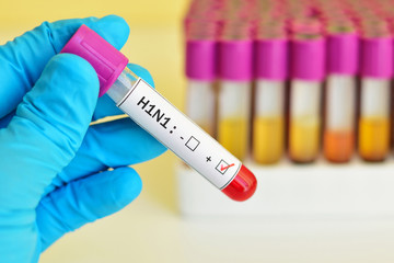 Obraz premium Blood sample positive with H1N1 influenza virus 
