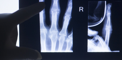 Hand fingers xray test scan
