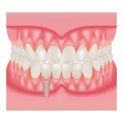 Human Jaw Model With Teeth And Implant. Installation Of Dental Implants Isolated On A White Background. Vector Illustration. Stomatology. Teeth And Tooth Concept Of Dental