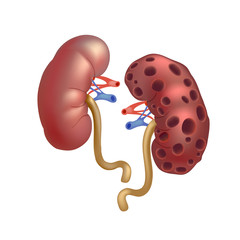 Realistic human sick kidneys isolated on white background.
