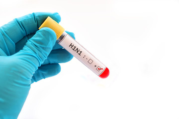 Blood sample positive with H1N1 influenza virus
