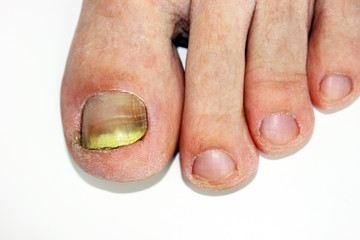 Fungus infection on nails of man's foot, to cause a pain to man