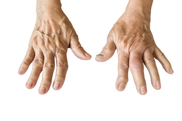 Arthritis of old woman's hand