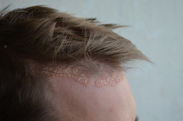 Psoriasis on the skin close-up, scalp, photos of dermatitis and eczema, skin problems, dermatology