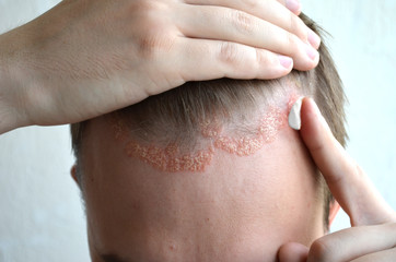 Anoint with cream, ointment, medicine forehead, hair line, scalp with psoriasis, dermatitis,...