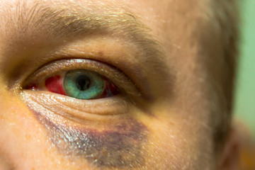 The usual injury after sparring. Traumapony sport which gives vigor to life.