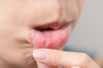 Woman mouth suffer from aphtha