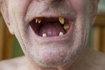 Naklejka premium The old man with unshaven bristles opened his mouth and inside the yellow teeth