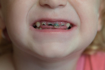 Fototapeta premium Not healthy baby's front teeth with black caries