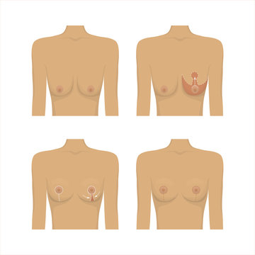 Lifting breast plastic surgery. Cosmetic procedure of mastopexy, technique and method. Female healthcare concept. Medical clinic poster. White background vector illustration