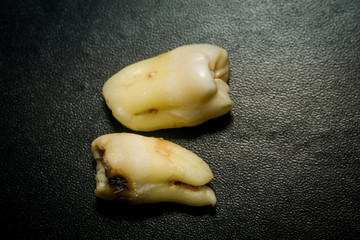 Tooth After Extraction