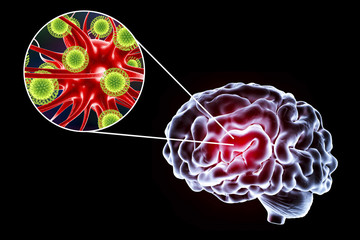 Viral encephalitis, 3D illustration showing brain and close-up view of viruses amd neurons