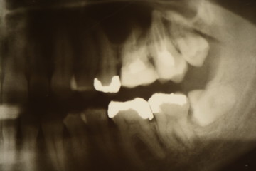 Zahnfüllung, Röntgenbild, Wurzelkanalbehandlung, Zahnarzt, Zahnarztbesuch, Zahnzusatzversicherung, Zahn, Wurzelkanal