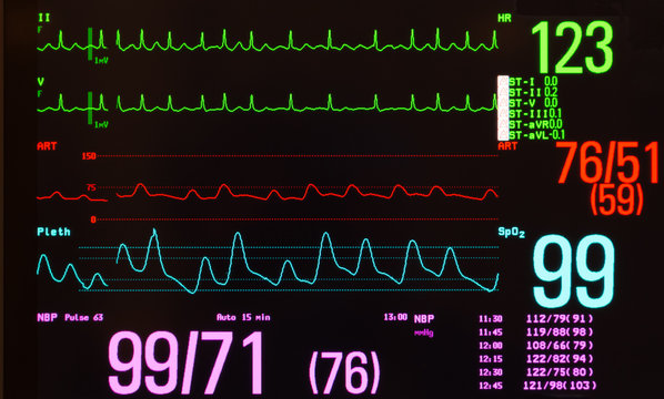 Monitor with a black background showing atrial flutter on the green ECG lines, arterial blood pressure on the red line, noninvasive blood pressure in purple and oxygen saturation on the blue line. 