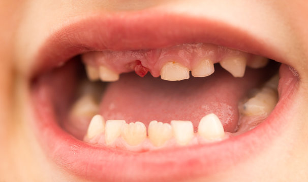 The mouth of a boy without a tooth