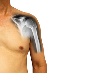 Human shoulder with x-ray show fracture at neck of humerus ( Arm bone ) . Isolated background . Blank area at right side