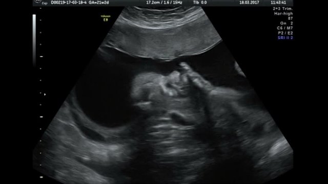 Ultrasound baby 22 weeks
