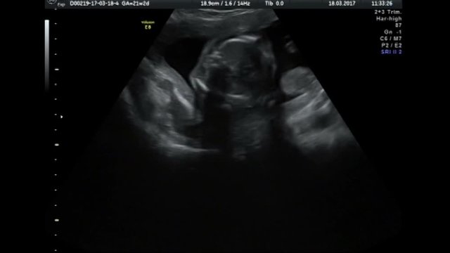 Ultrasound baby 22 weeks