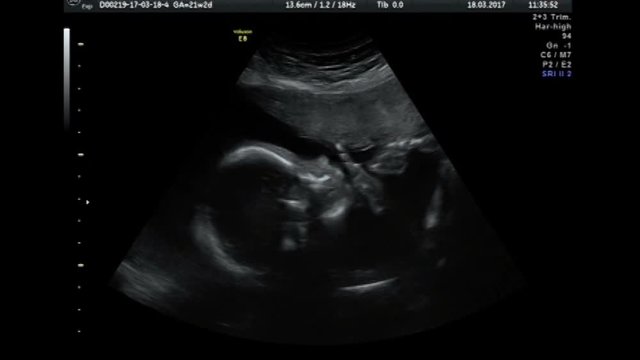 Ultrasound baby 22 weeks