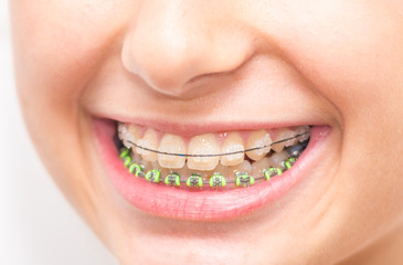 Stock photo of the metal braces