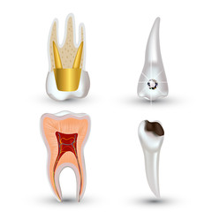 Vector set of 3d realistic clean and dirty tooth isolated on white background. Dental health Concept. Oral Care, teeth restoration
