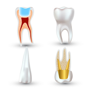 Vector set of 3d realistic clean and dirty tooth isolated on white background. Dental health Concept. Oral Care, teeth restoration