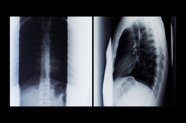 Fluorography of the spine
