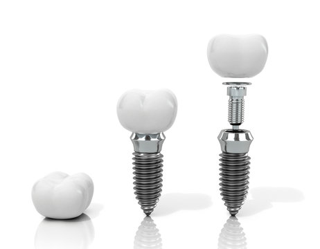 Dentures and implants on a white background. 3D illustration