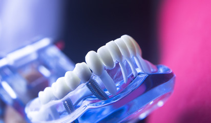 Dentists dental tooth model