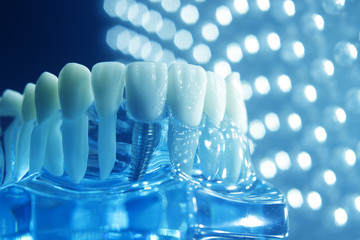 Dentists dental teeth implant