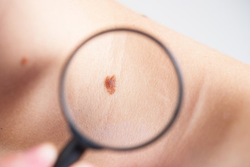 Investigation of moles on the body, diagnosis of skin diseases