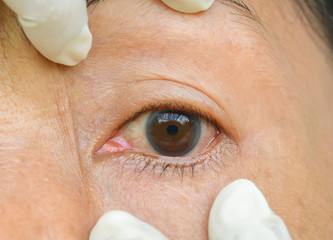 Eyes with chemical allergies