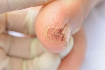 Blisters on the feet