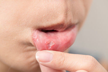 Woman suffer from mouth aphtha
