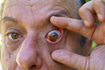 Eye, bloodshed to the eye, warts and papilla