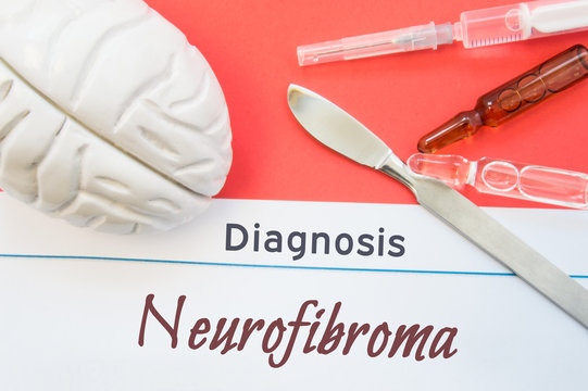 Brain figure, surgical scalpel, syringe and vials lying around title Diagnosis Neurofibroma. Concept photo for diagnosis, surgical and medicinal treatment of brain diseases Neurofibroma